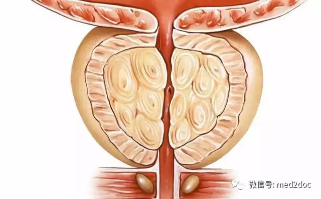 早期前列腺增生怎么治疗