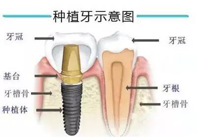 种牙大概多少钱一颗牙