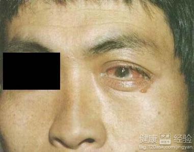 红眼病怎么传染给别人的,红眼病传染途径解析及高速响应方案探讨——R版59.19.70,专家解读说明_Prime95.26.45