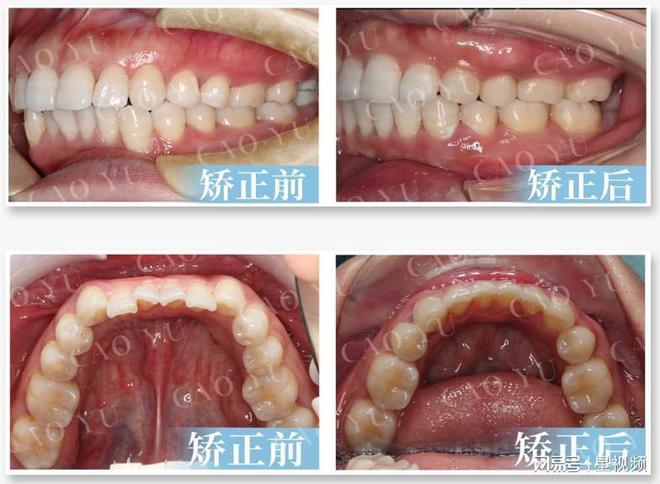 龅牙矫正牙齿要多少钱,龅牙矫正牙齿费用详解，深层策略设计解析,实地验证分析_Pixel25.13.39