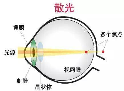 角膜屈光手术是啥意思