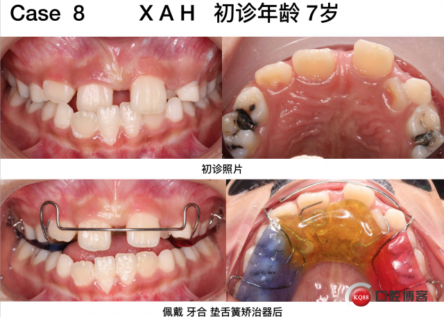 牙反颌矫正器,最新热门解答关于牙反颌矫正器的定义与金版67.35.89详解,快速设计解答计划_专属款70.86.80