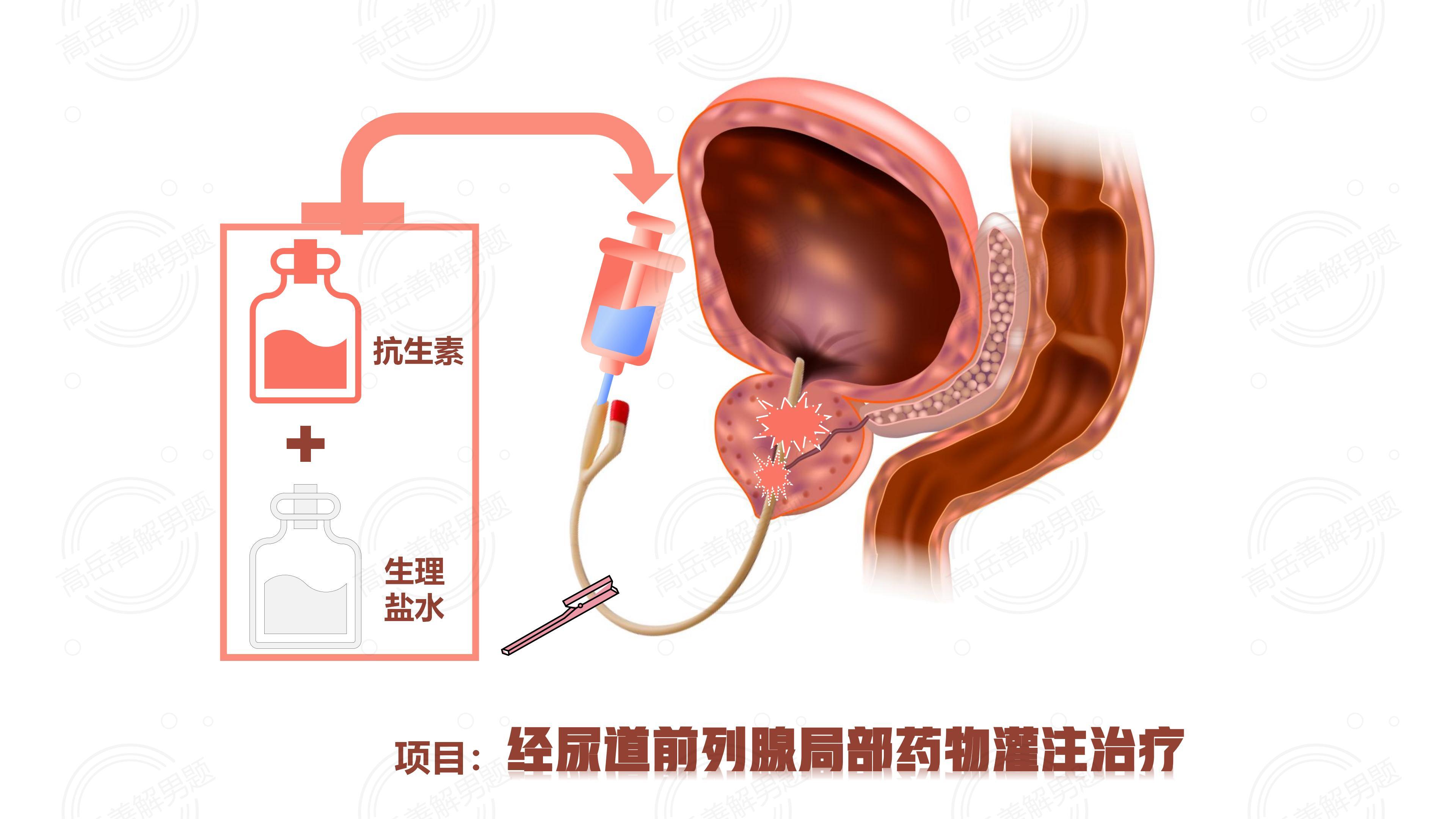 前列腺炎好治吗,大概花多少钱,前列腺炎的解析，治疗方法、费用及全面说明,经典解读说明_轻量版97.65.47