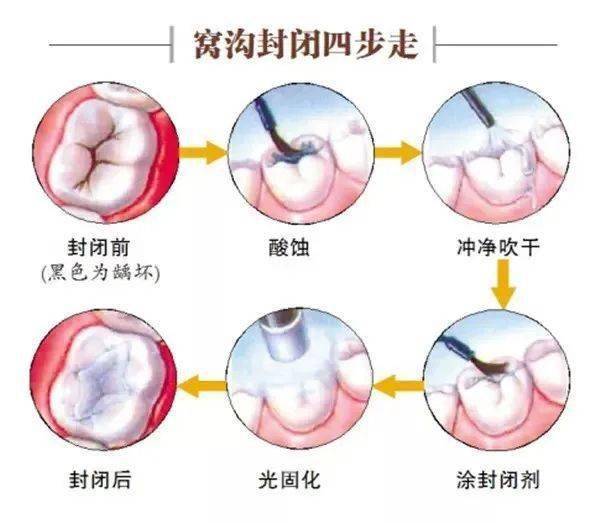 斑氟牙可以洗掉吗