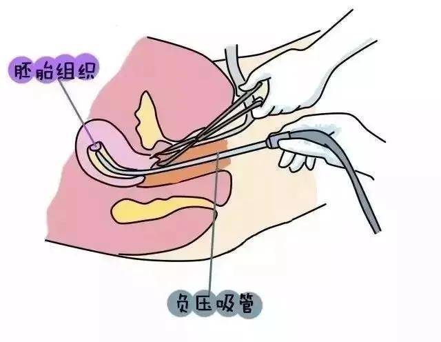 上海仁爱医院人流手术怎么样