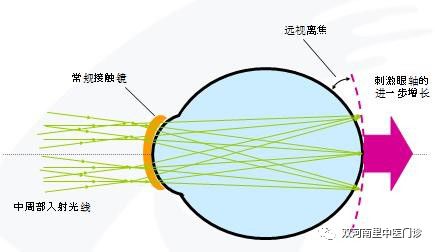 角膜塑型镜的好处和危害