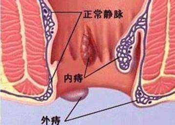 屁股痔疮外痔肉球怎么消除