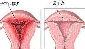 子宫内膜炎出血多吗