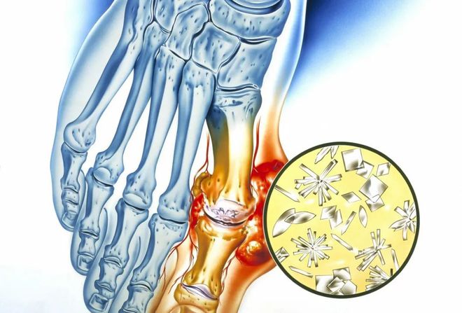 小伙长期喝饮料双手长满痛风石，实地评估与健康导航策略