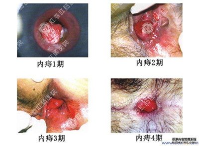 男子患痔疮喷血三个月致重度贫血，数据资料解读与AR版分析